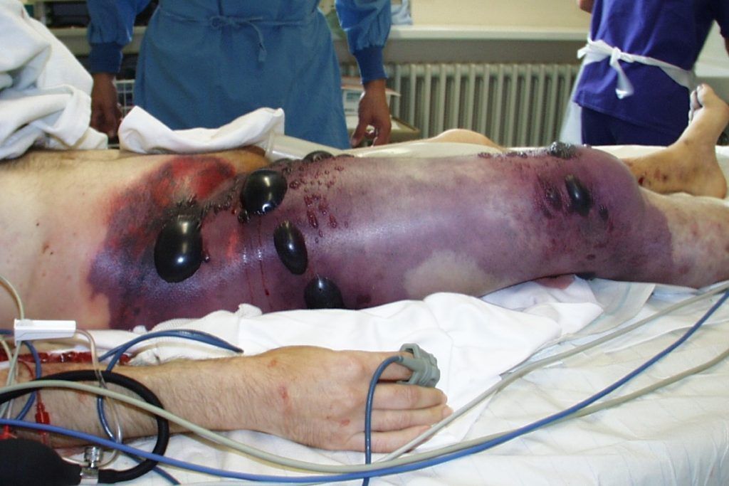 Oxigenoterapia Hiperbárica para la Gangrena Gaseosa 1 Gangrena Gaseosa - Mionecrosos Clostridial